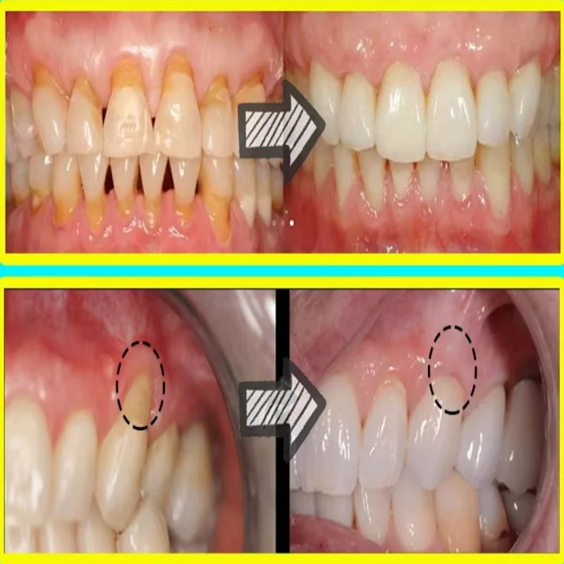 Snel Reparatie Tandvlees Serum - Teeth Whitening With Baking Soda recensie en prijs