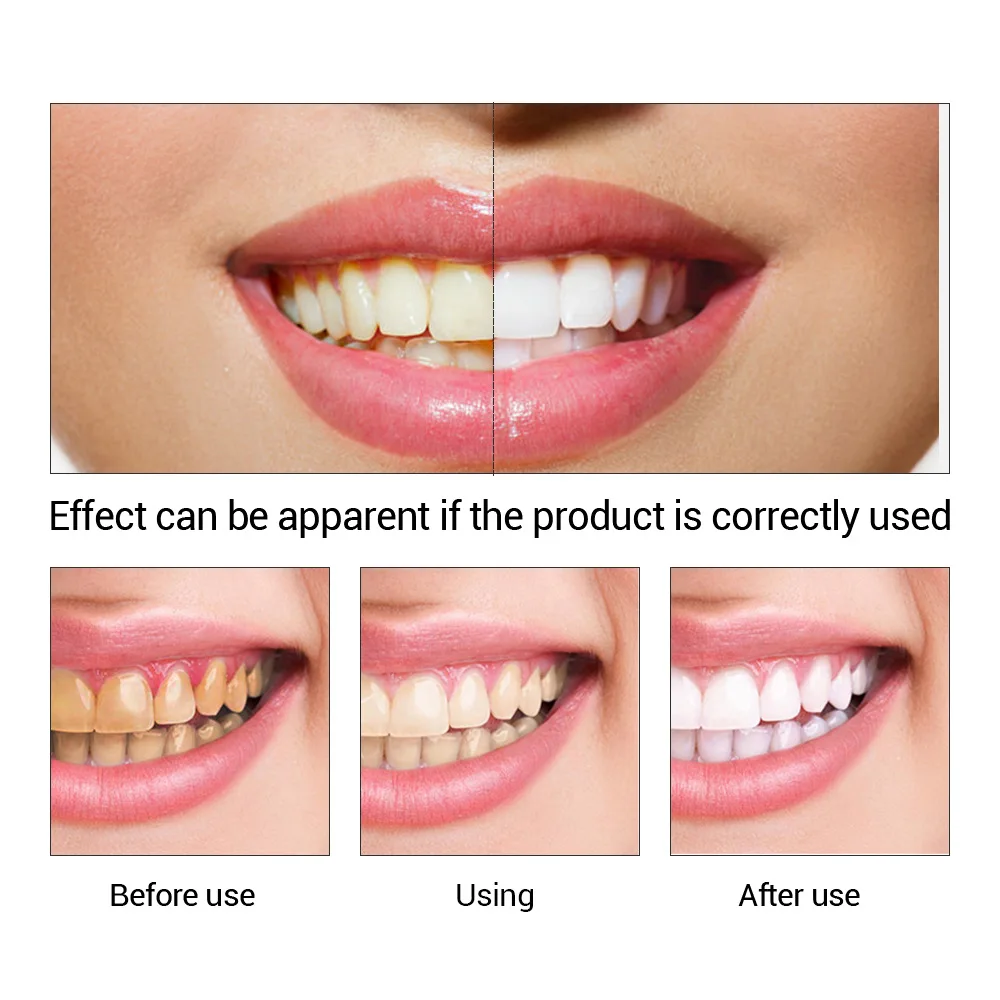Fteenply Tanden Whitening Esse - Teeth Whitening At Home recensie en prijs