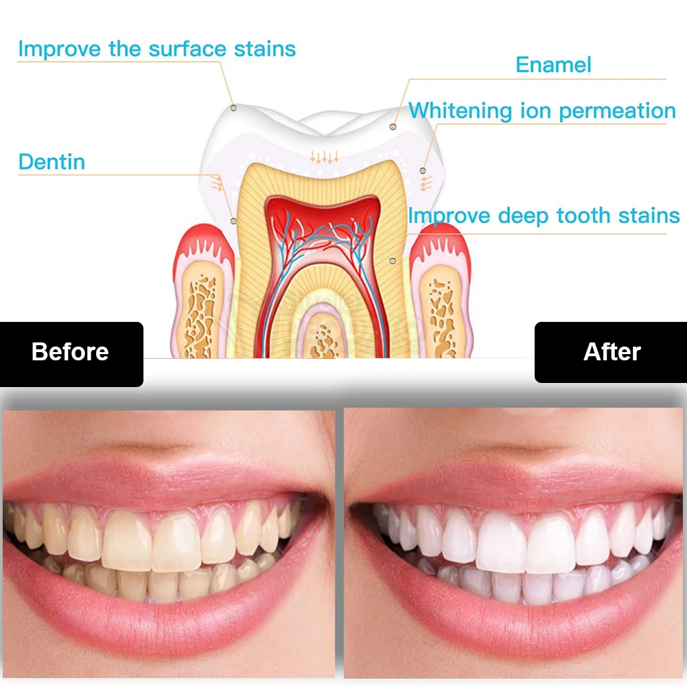 Tandheelkundige Tanden Whiteni - Teeth Whitening With Trays recensie en prijs