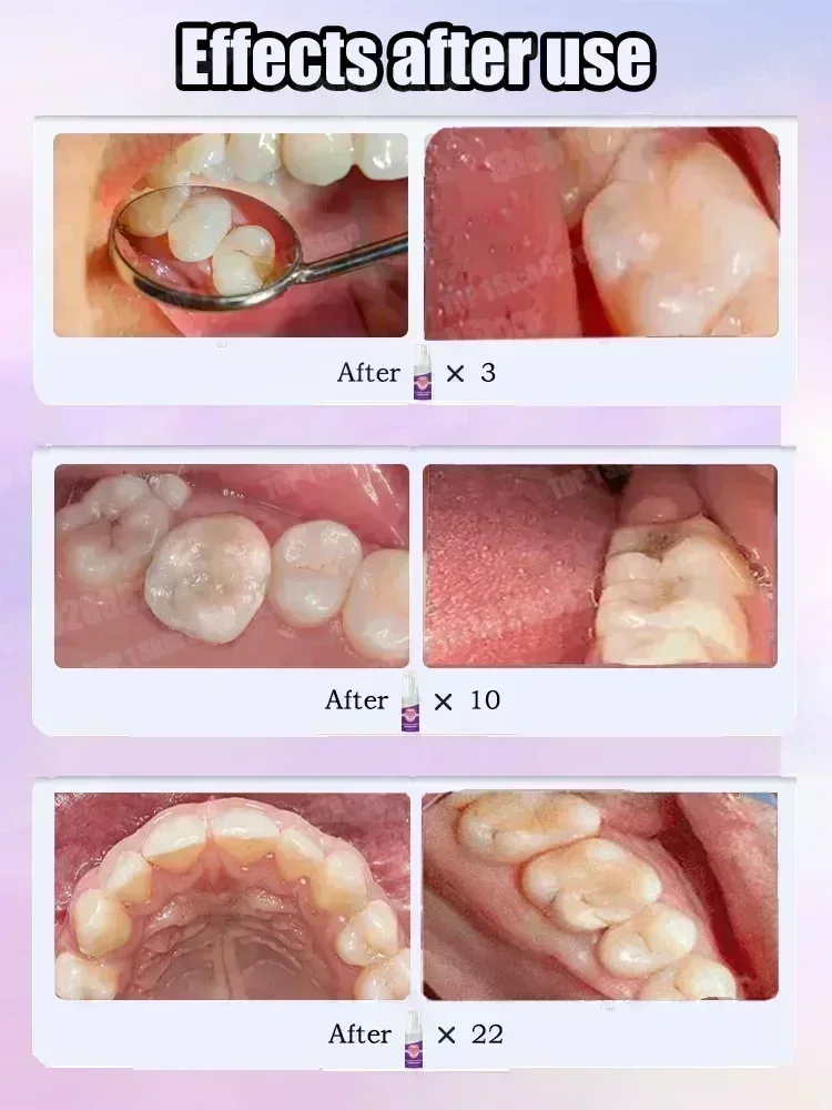 Hete verkoop Best verkochte, w - Teeth Whitening Treatment recensie en prijs
