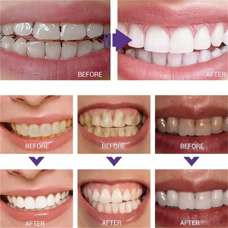 Snelle Tanden Whitening Tandpa - Whitening Pen Bleach recensie en prijs
